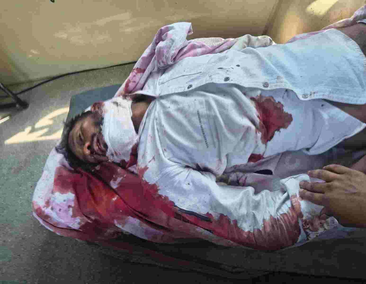 ईंट से जानलेवा हमला: पैसों के विवाद में युवक गंभीर घायल, आरोपी पर मामला दर्ज